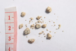 small kidney stones