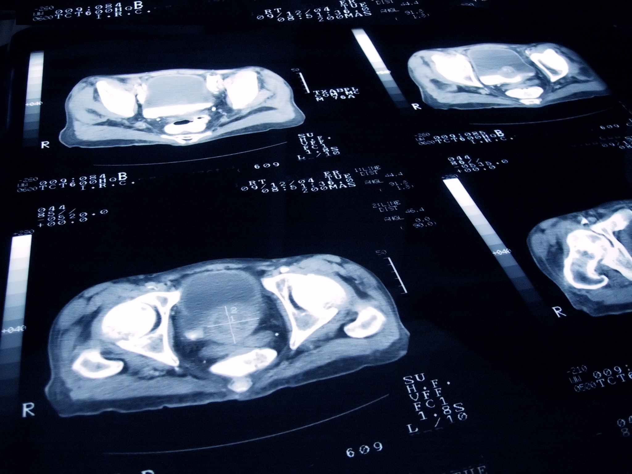 Advanced Prostate Cancer – Urology Austin